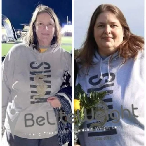 Weight Loss Surgery Gastric Sleeve before and after